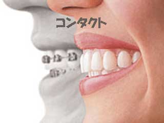 インビザラインの質問