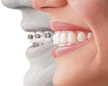 インビザライン歯並び治療のメリット、デメリット